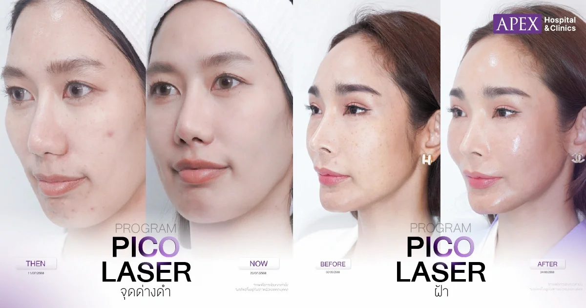 ผลลัพธ์หลังทำ Pico Laser