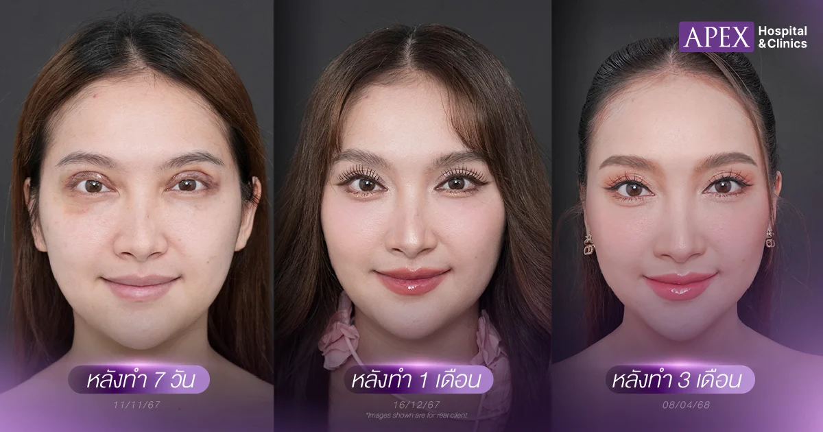 รีวิวตาสองชั้น