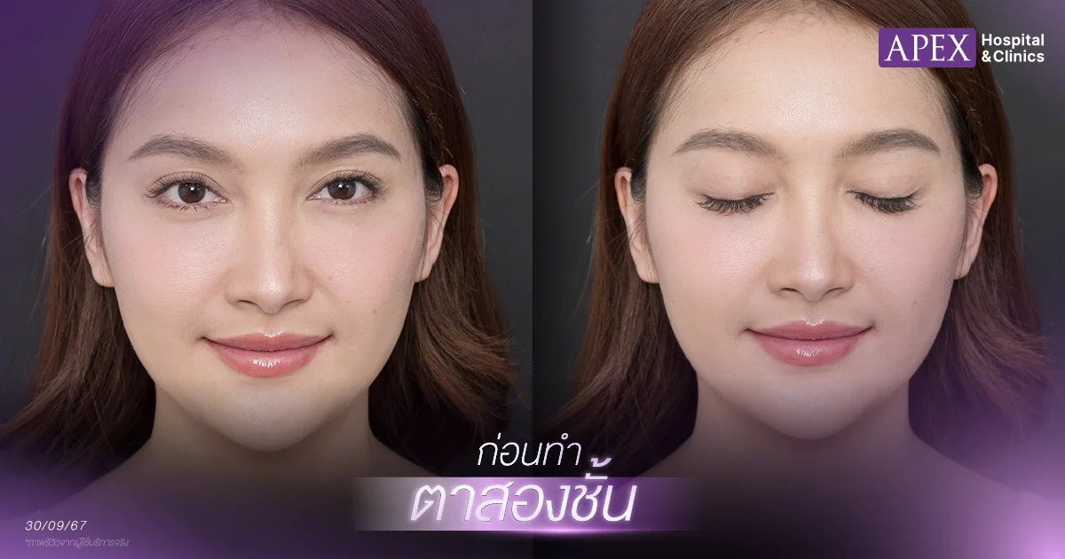 รีวิวตาสองชั้น