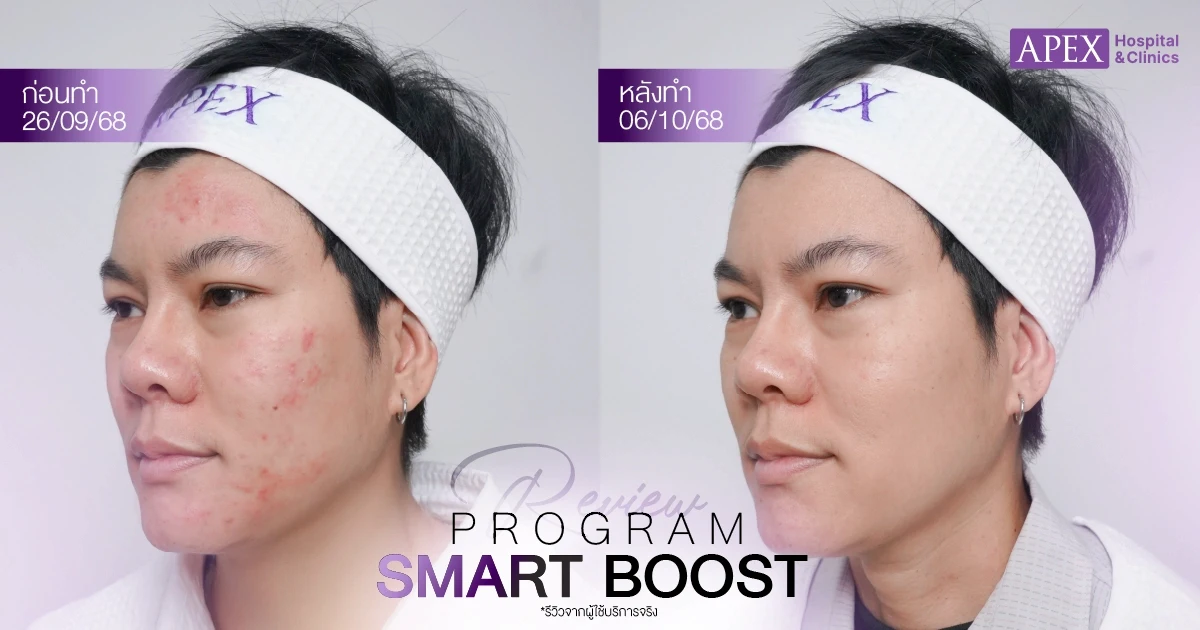 รีวิว Smart Boost