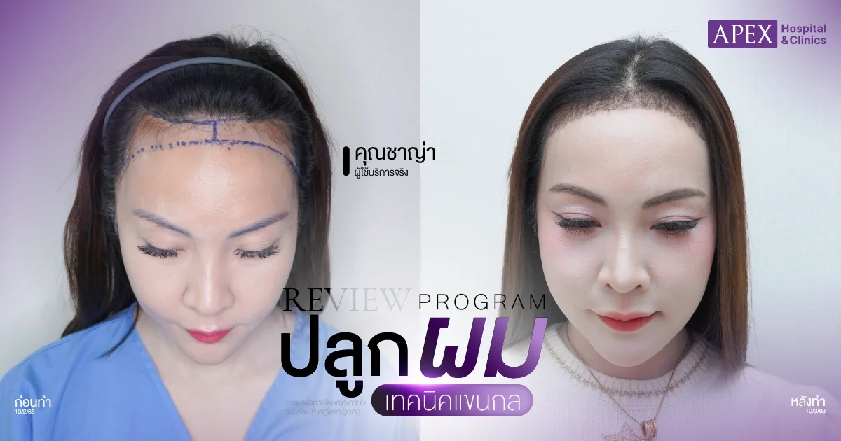 รีวิวปลูกผมที่ไหนดี