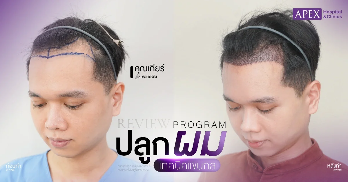 รีวิวปลูกผมที่ไหนดี
