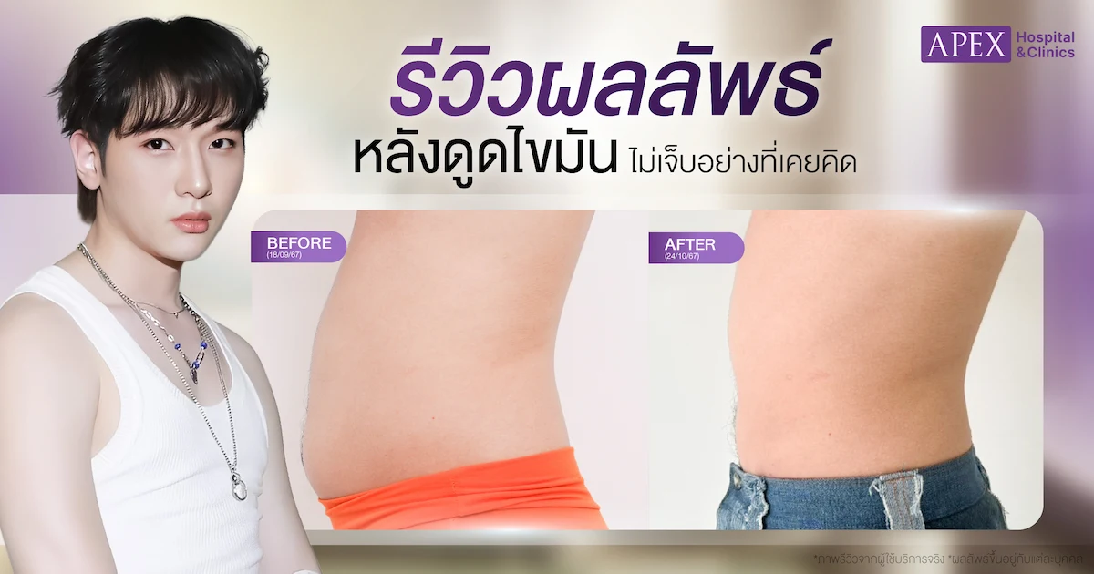 ดูดไขมันเจ็บไหม รีวิวผลลัพธ์