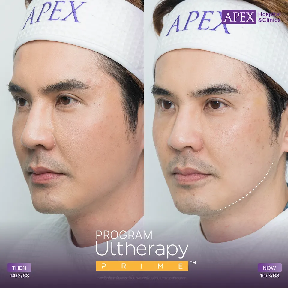 Ulthera Prime ราคาต่างกันไหม