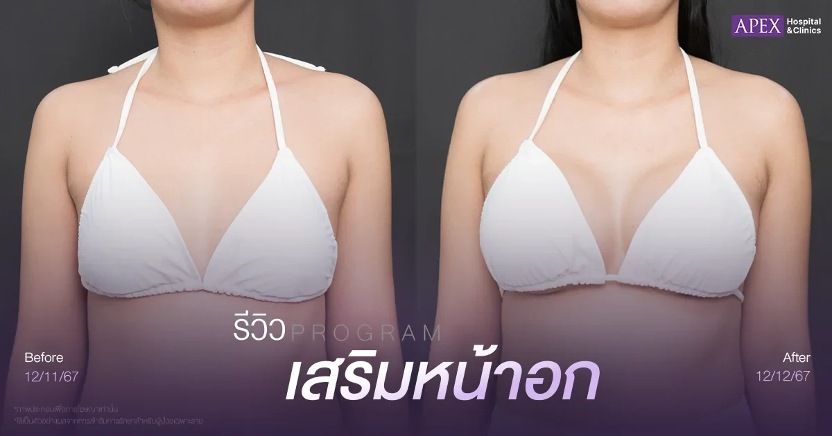 แก้หน้าอกเล็กรีวิว