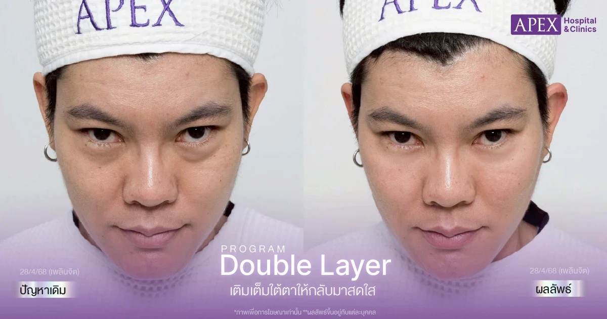 ฟิลเลอร์ใต้ตา ช่วยเรื่องอะไรบ้าง