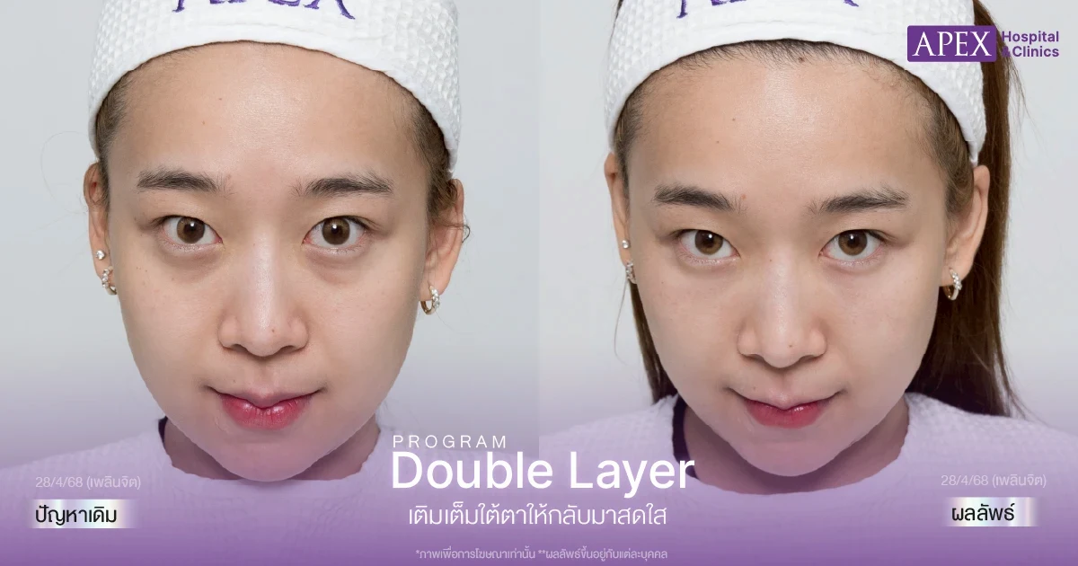 ฟิลเลอร์ใต้ตาที่ไหนดี
