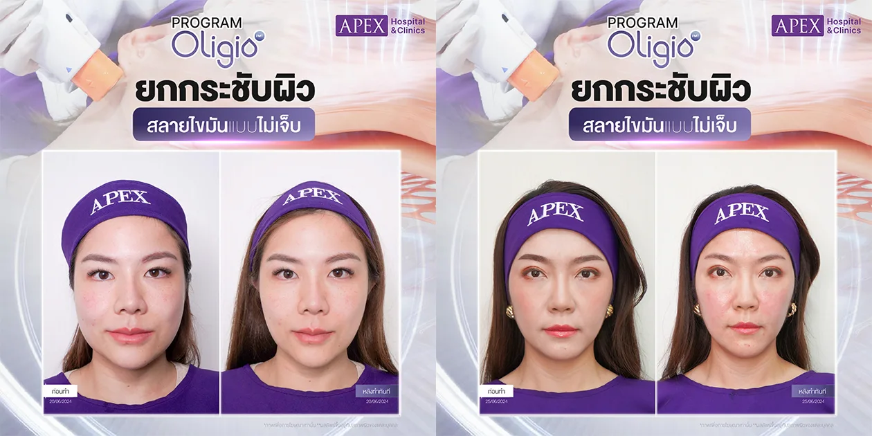 รีวิวทำ Oligio ที่ไหนดี