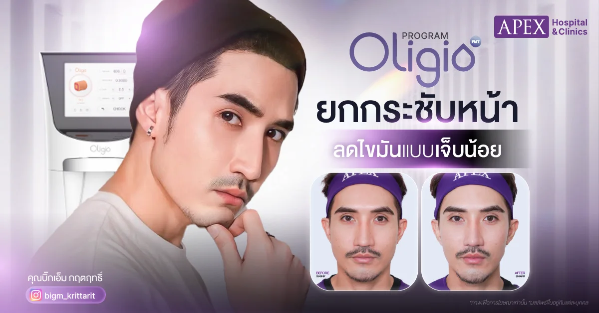 Oligio กี่วันเห็นผล รีวิว