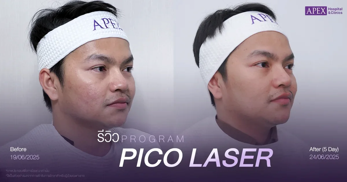 pico laser รีวิว