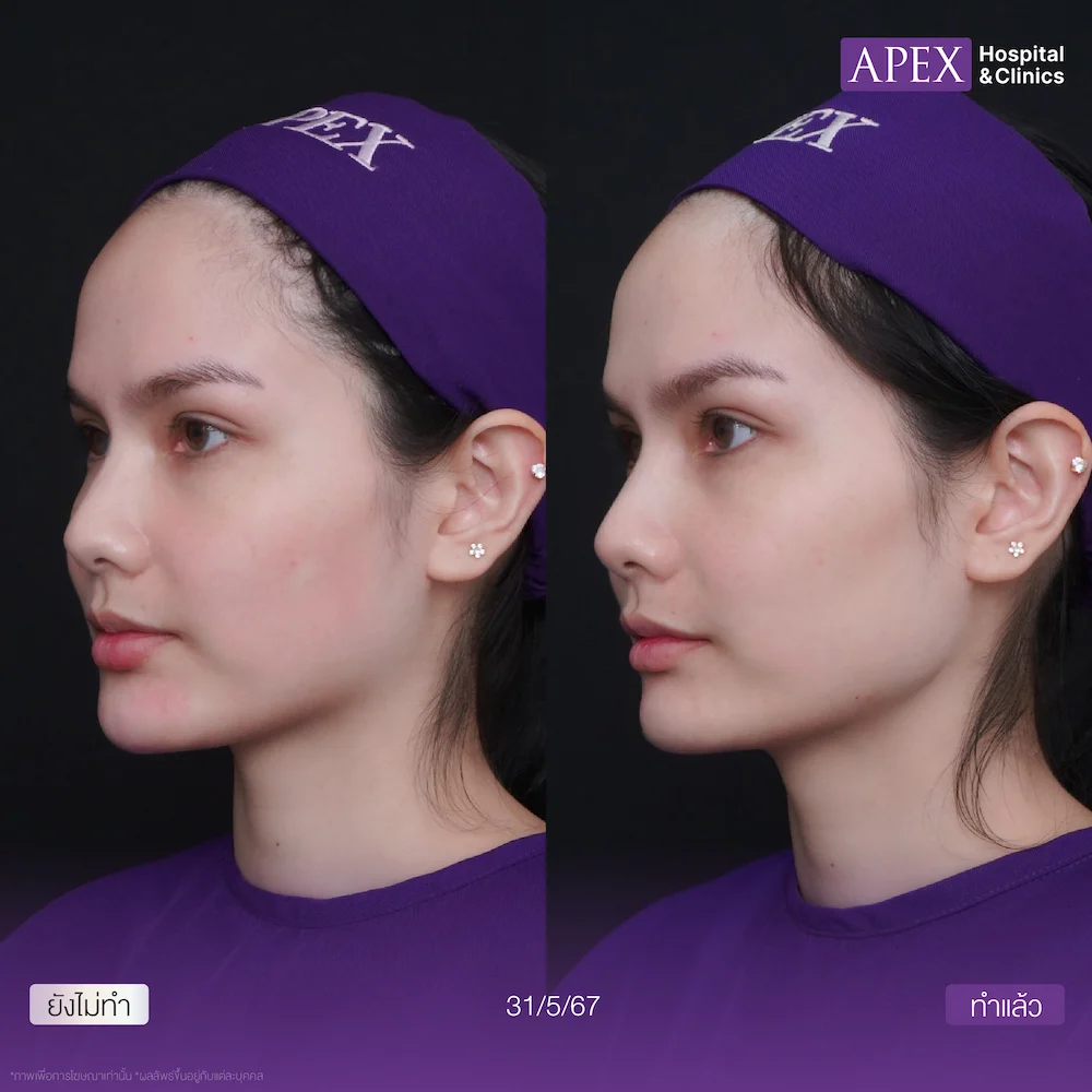 หน้าตอบ Radiesse