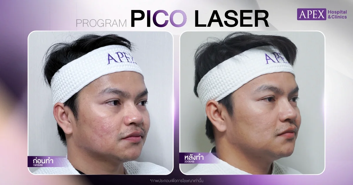 ผลลัพธ์หลังทำ Pico Laser