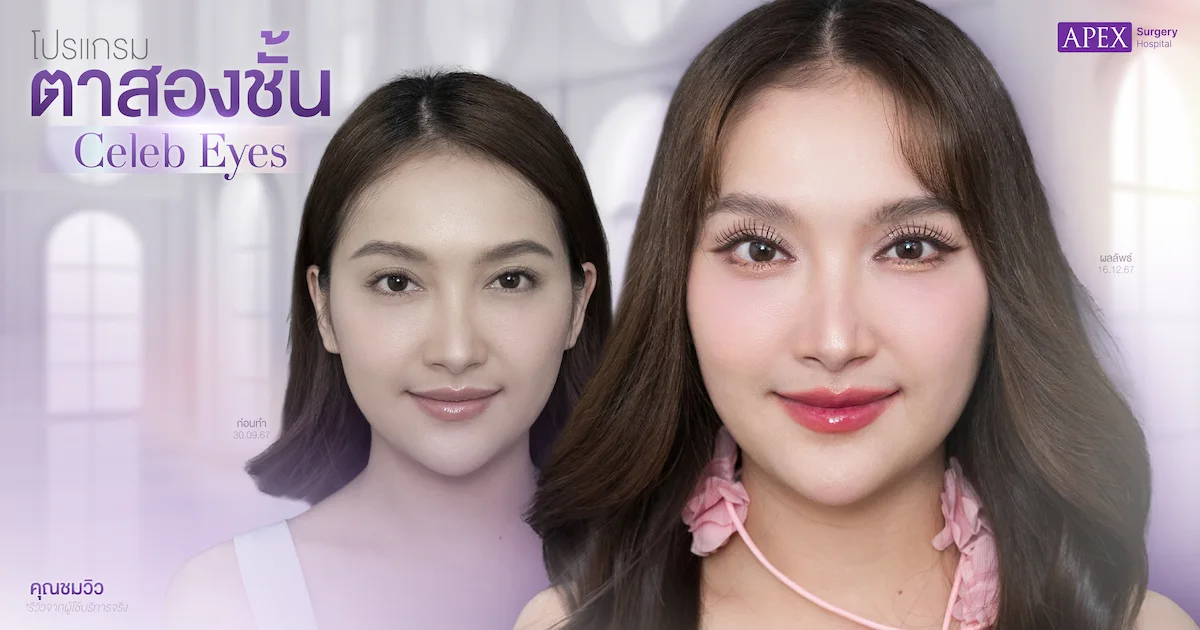 รีวิวตาสองชั้น คุณชมวิว