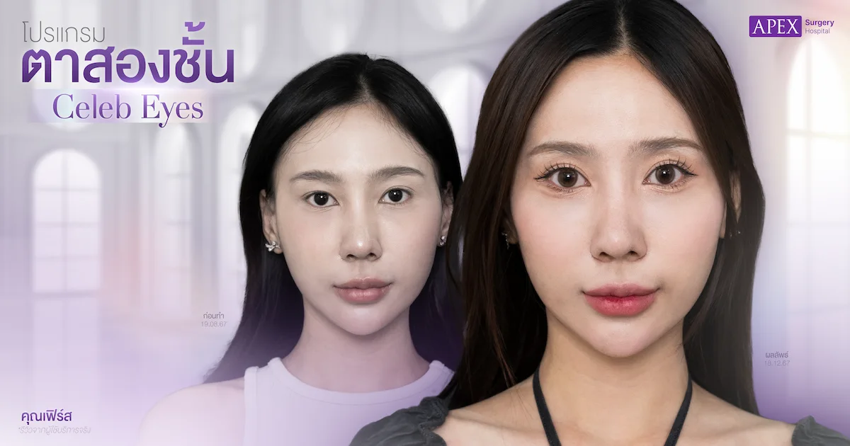 รีวิวตาสองชั้น คุณเฟิร์ส