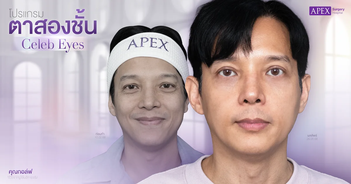 รีวิวตาสองชั้นคุณกอล์ฟ