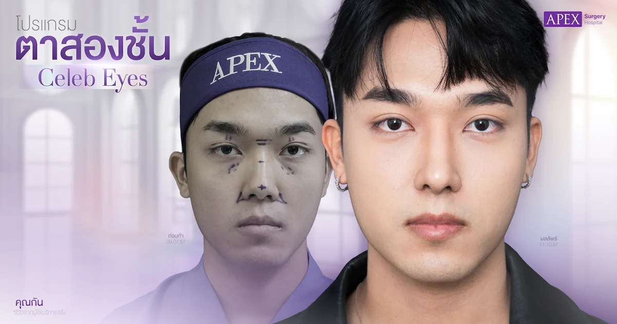 รีวิวตาสองชั้น คุณกัน