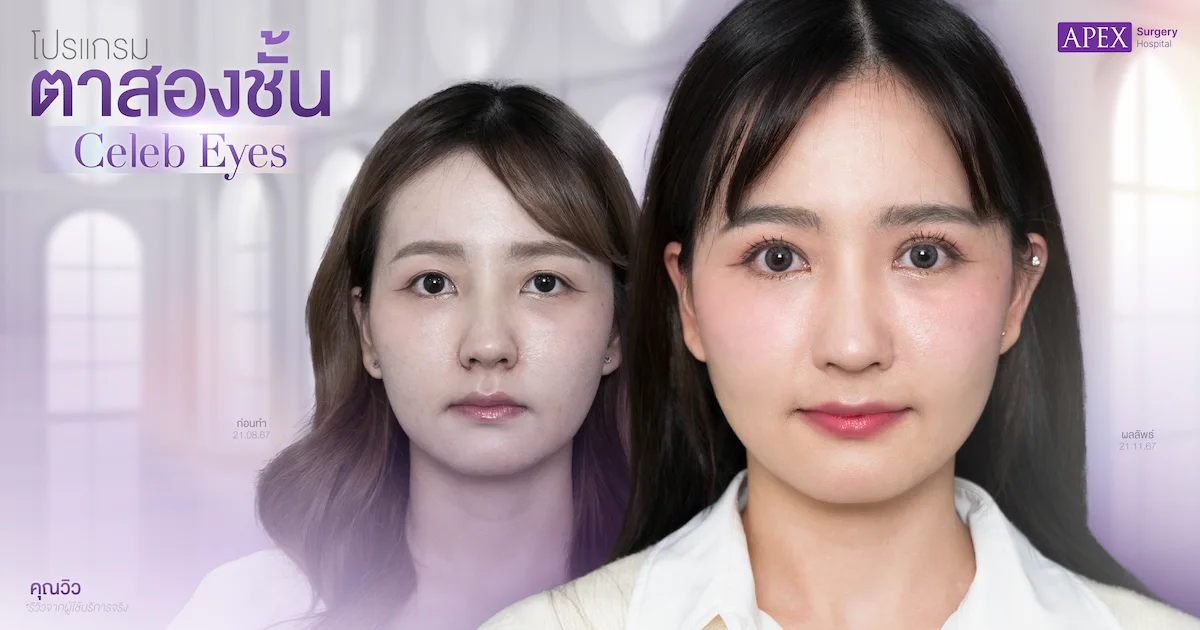 รีวิวตาสองชั้น คุณวิว