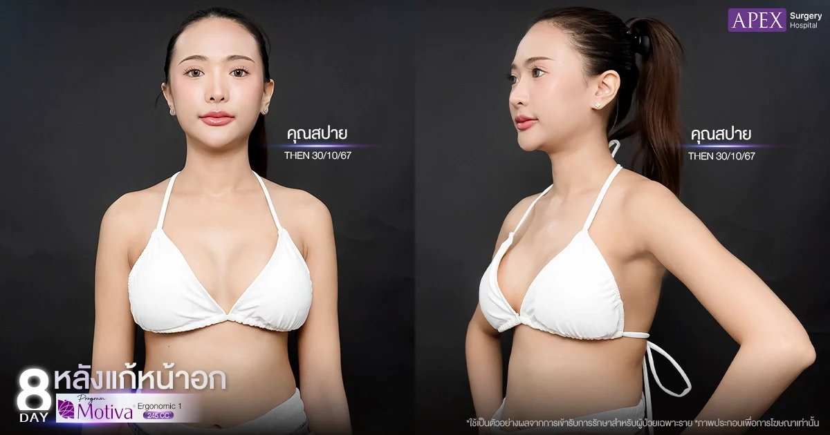 คุณสปาย รีวิวแก้หน้าอกหลังครบ 8 วัน