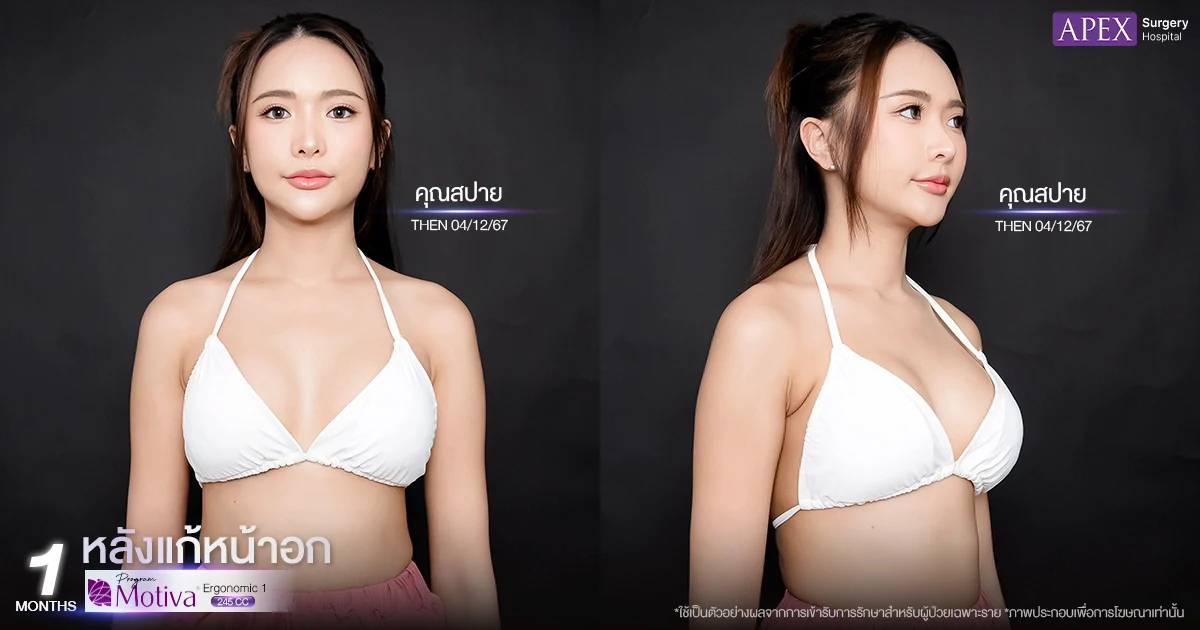 คุณสปาย รีวิวแก้หน้าอกหลังครบ 1 เดือน