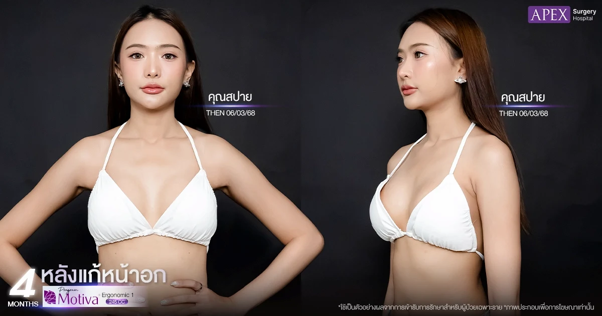 คุณสปาย รีวิวแก้หน้าอกหลังครบ 4 เดือน