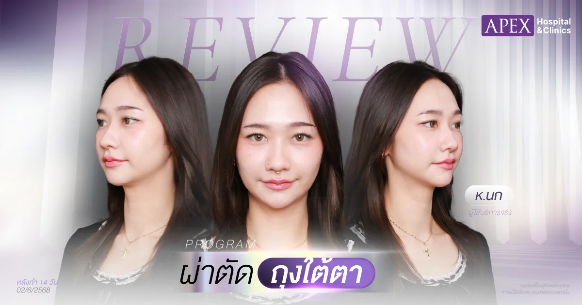 รีวิวผ่าตัดถุงใต้ตา คุณนก 14 วัน