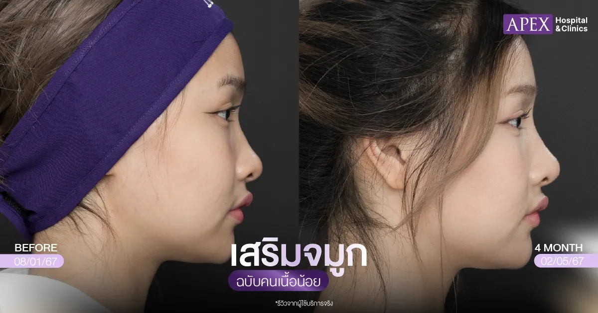 รีวิว เสริมจมูกเนื้อน้อย