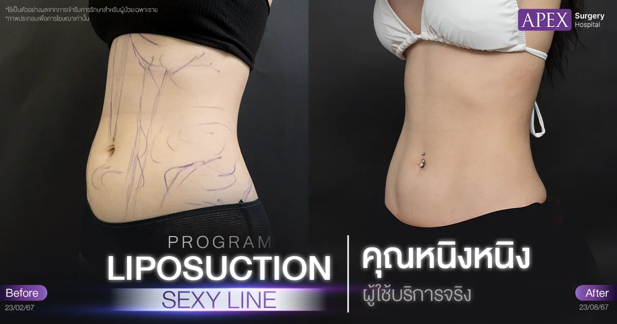 ดูดไขมัน Sexy Line รีวิว Before & After