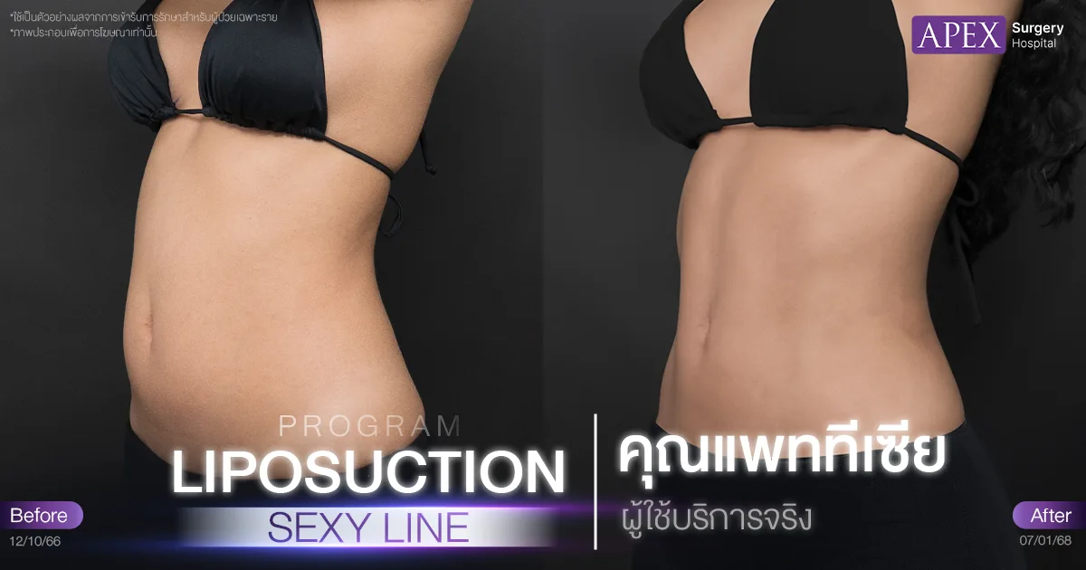 ดูดไขมัน Sexy Line รีวิว Before & After