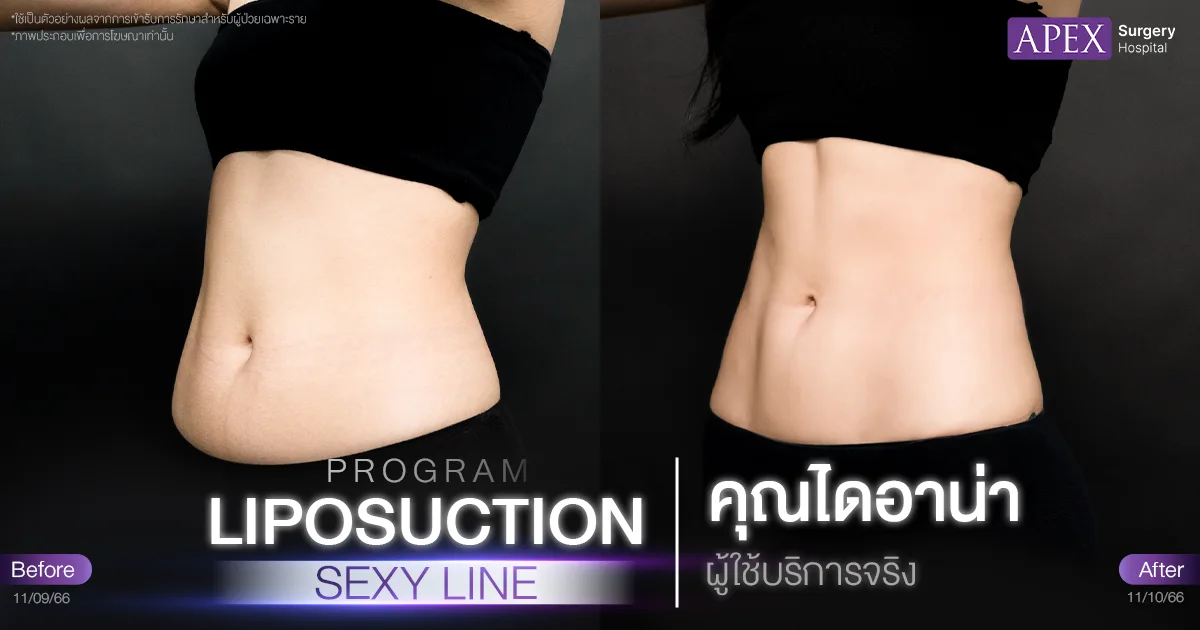 ดูดไขมัน Sexy Line รีวิว Before & After
