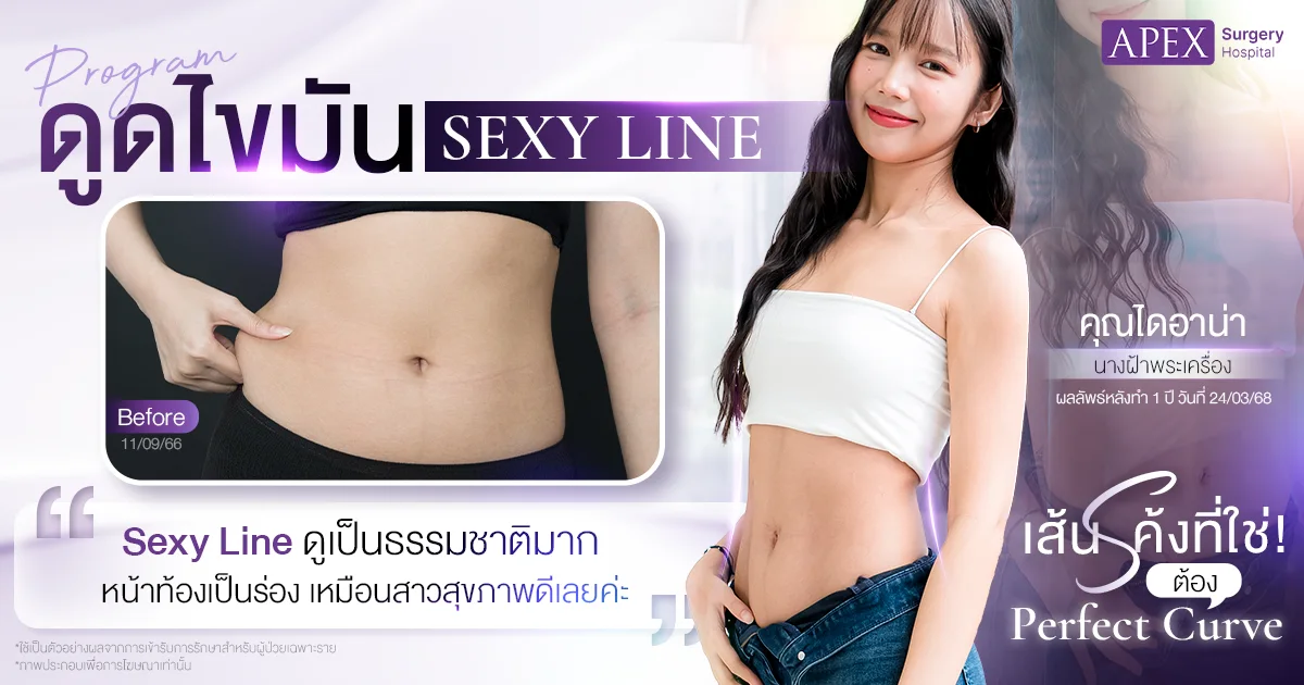 รีวิวดูดไขมัน Sexy Line