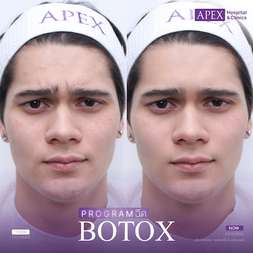 รีวิว Botox หยุดหน้ายุบ