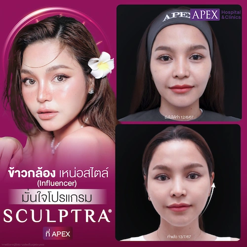 รีวิว Sculptra หยุดหน้ายุบ