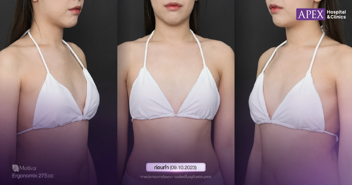 ปัญหาของคุณกู๊ดดี้ ก่อนเสริมหน้าอก