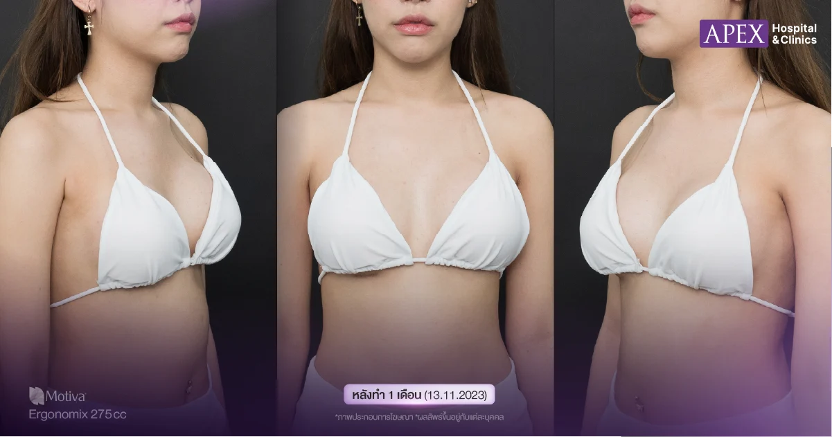 รีวิวเสริมหน้าอก กู๊ดดี้ 1 เดือน