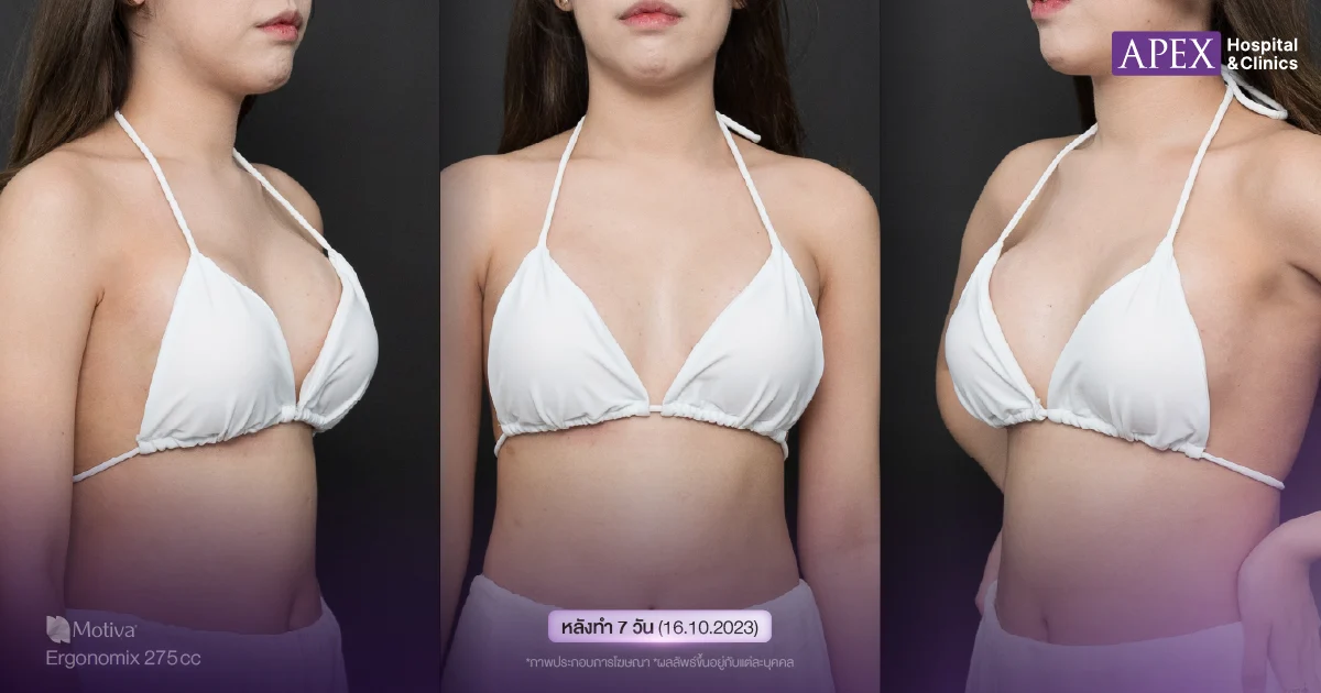 รีวิวเสริมหน้าอก กู๊ดดี้ 7 วัน