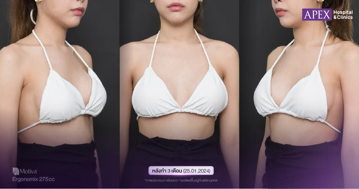 รีวิวเสริมหน้าอก กู๊ดดี้ 3 เดือน