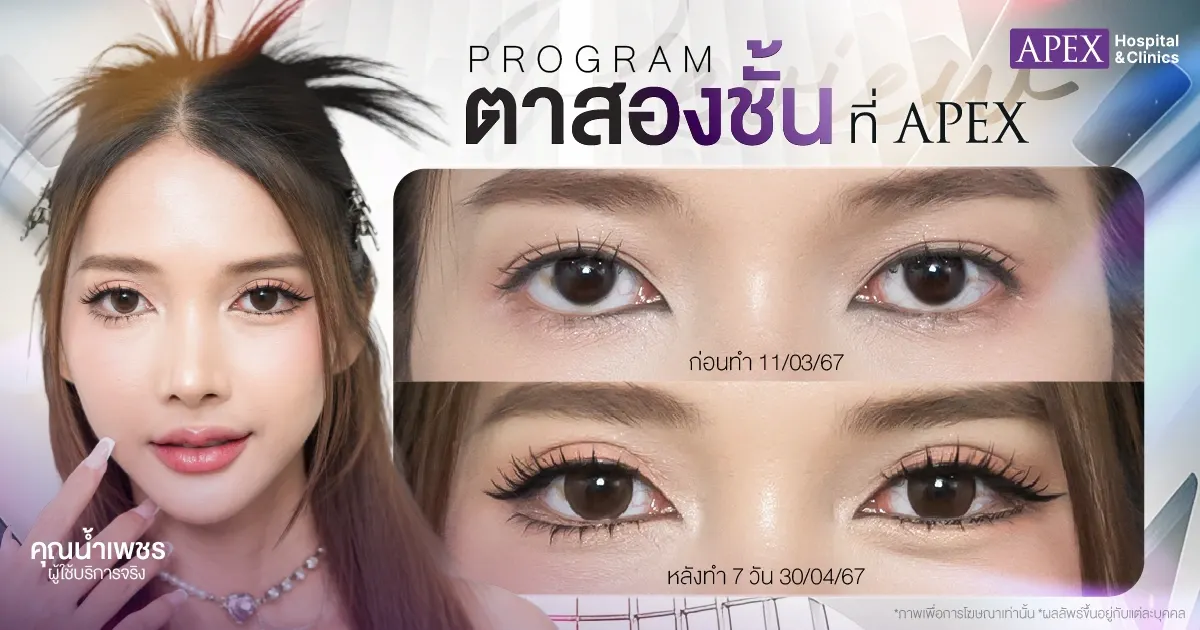 วิธีแก้ตาสองชั้นที่ทำมาแล้วไม่สวย