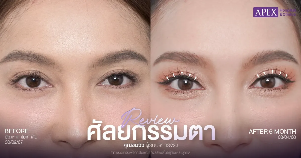 รีวิว ทำตาสองชั้นกี่เดือนเข้าที่