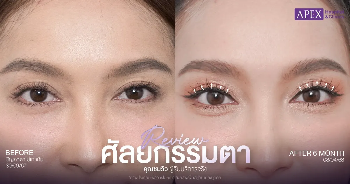 รีวิวทำตาสองชั้นกี่วันหาย