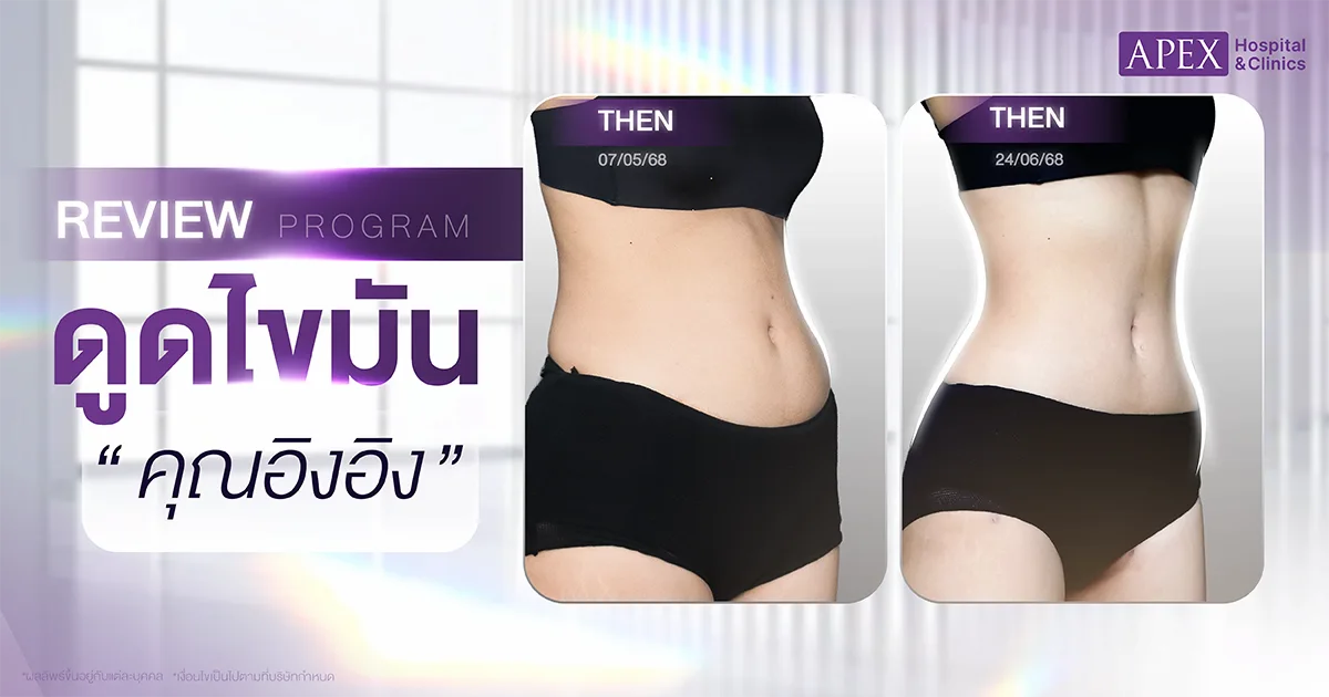 ดูดไขมันราคาเท่าไหร่ APEX Surgery Hospital
