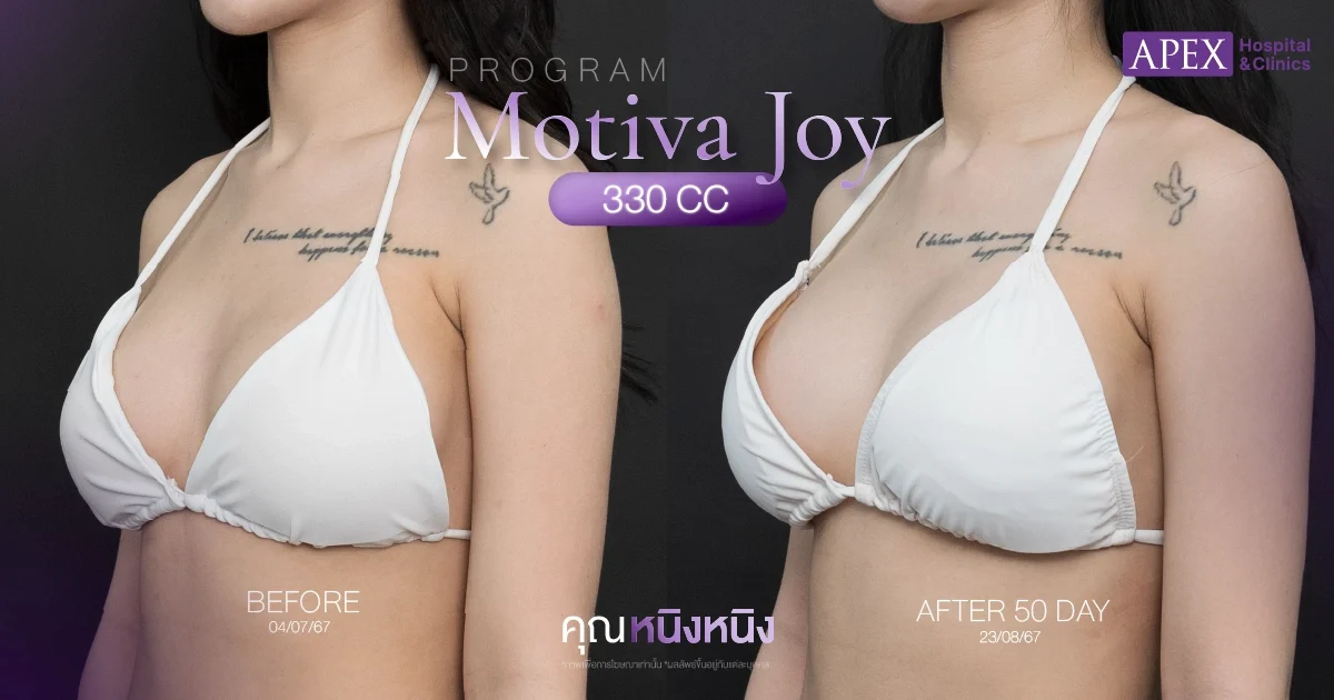 Motiva Joy รีวิวแก้หน้าอก