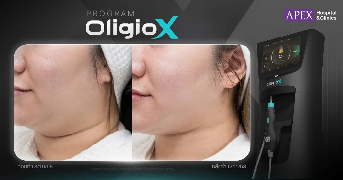 รีวิว OligioX vs Oligio 