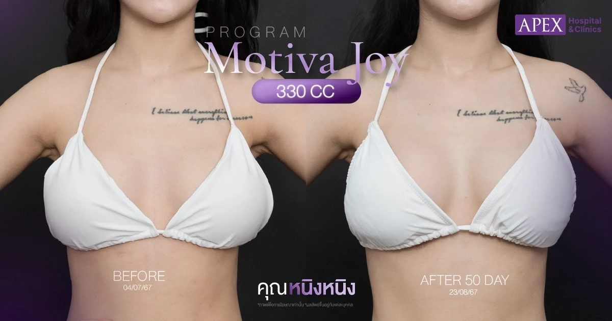 รีวิวแก้หน้าอก Motiva Joy