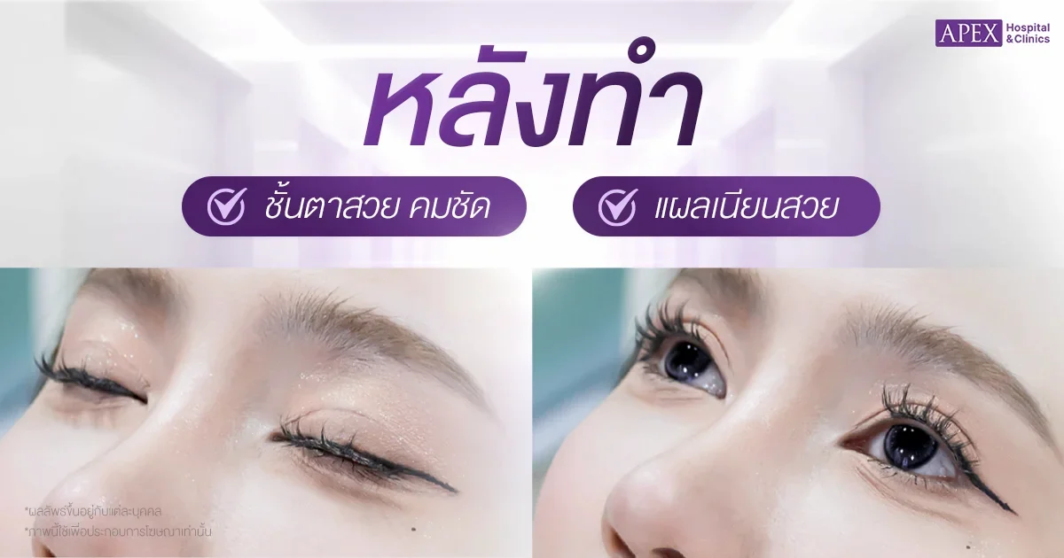 ทำตาสองชั้นกี่เดือนเข้าที่ ผลลัพธ์หลังทำในแต่ละช่วงเวลา