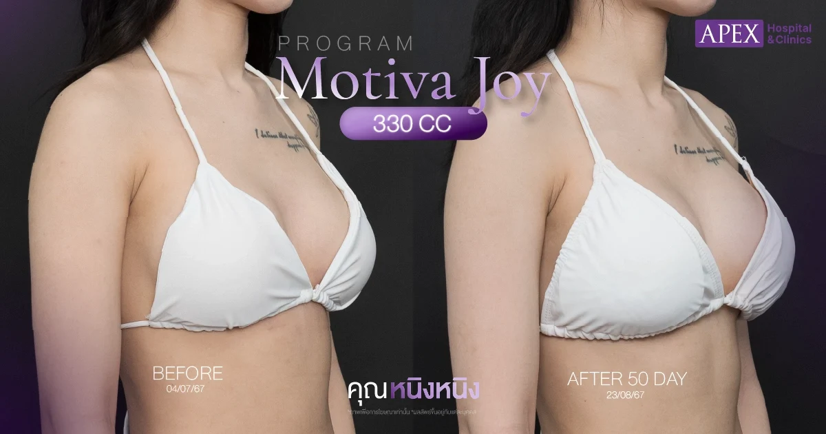 รีวิว Motiva Joy แก้หน้าอก