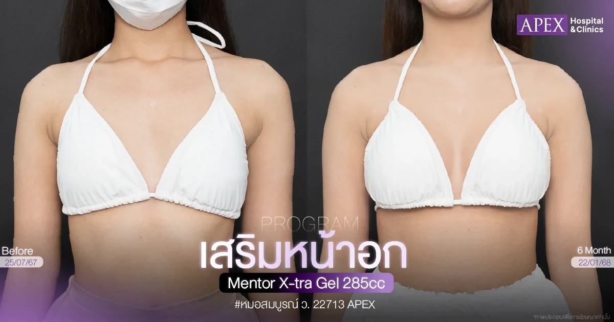 ซิลิโคนทำนม