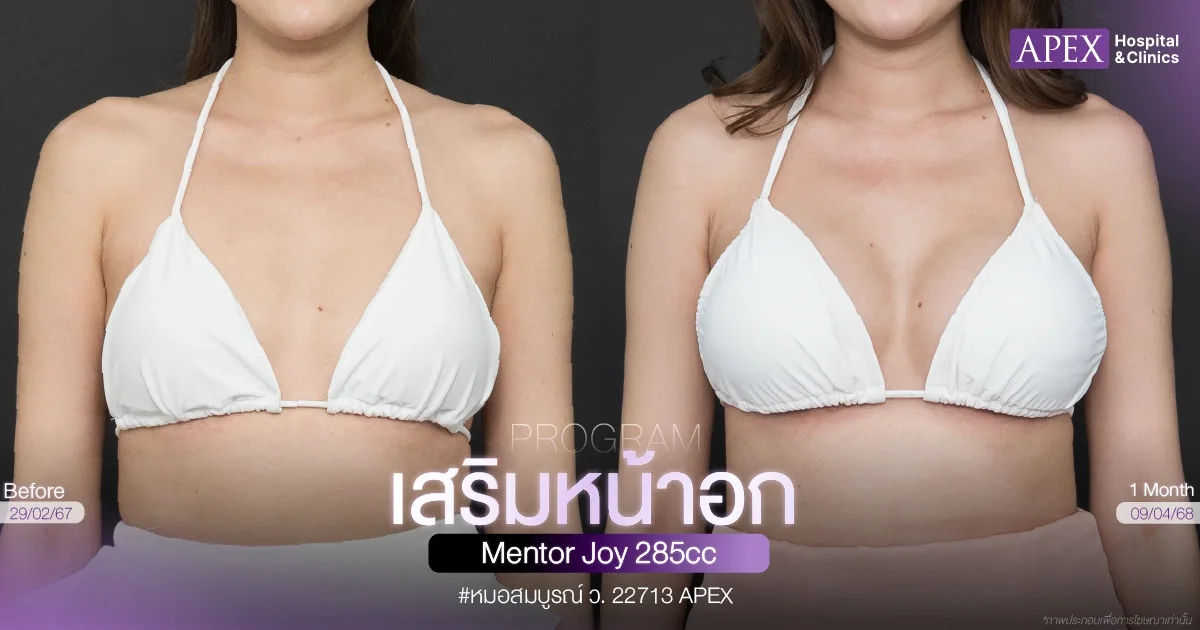 รีวิวผลลัพธ์ก่อน-หลังทำนม