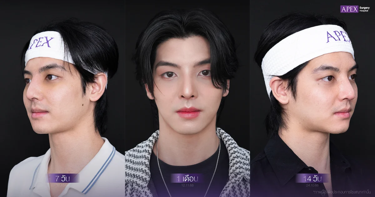 หลังเสริมจมูก 14 วัน กินอะไรได้บ้าง