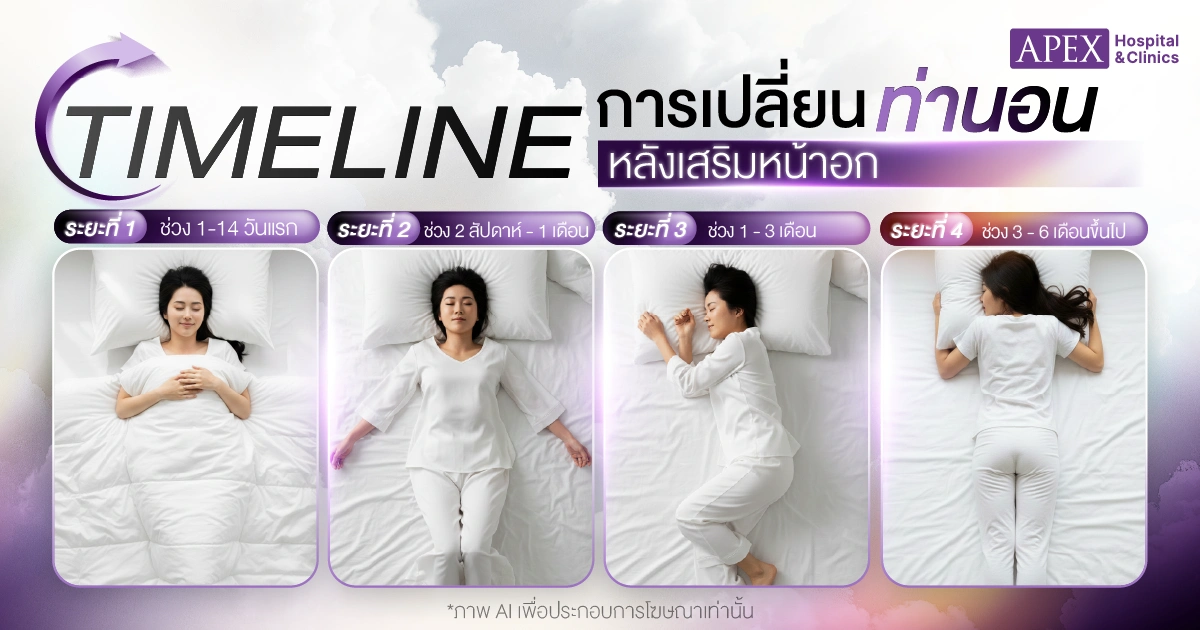 ไทม์ไลน์การเปลี่ยนท่านอนหลังเสริมหน้าอก