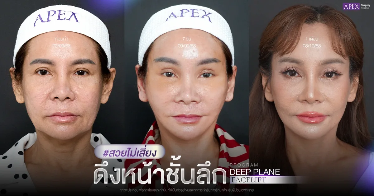 ดึงหน้ากี่วันหาย